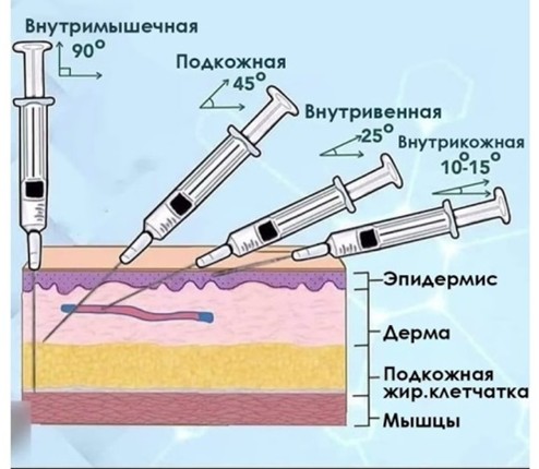 Виды инъекций